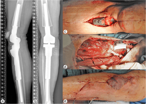 Lateral and anteroposterior radiographs of a megaendoprosthetic knee reconstruction with the implant correctly positioned.