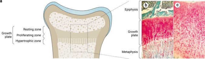 Paired histology of a healthy human growth plate and a rachitic growth plate showing disordered chondrocyte columns.
