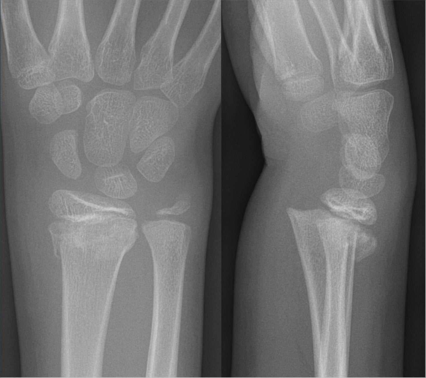 Anteroposterior and lateral radiographs of a child’s distal radius showing a Salter–Harris II fracture with a metaphyseal Thurston-Holland fragment.