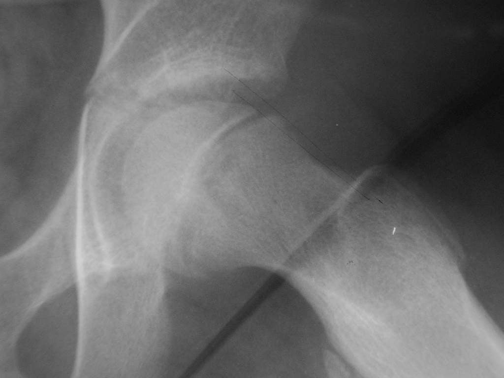 Frog-lateral radiograph of the pelvis showing a slipped capital femoral epiphysis on one side.