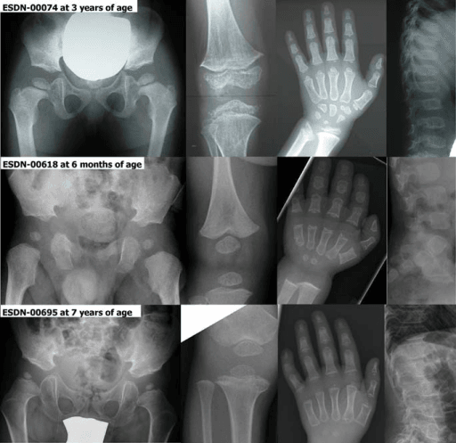 Panel of radiographs of spine, pelvis, knees and left hand in a child with a suspected skeletal dysplasia.
