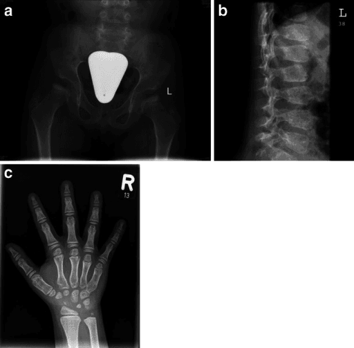 AP pelvis radiograph showing dysplastic capital femoral epiphyses and a lateral lumbar spine radiograph in a child.