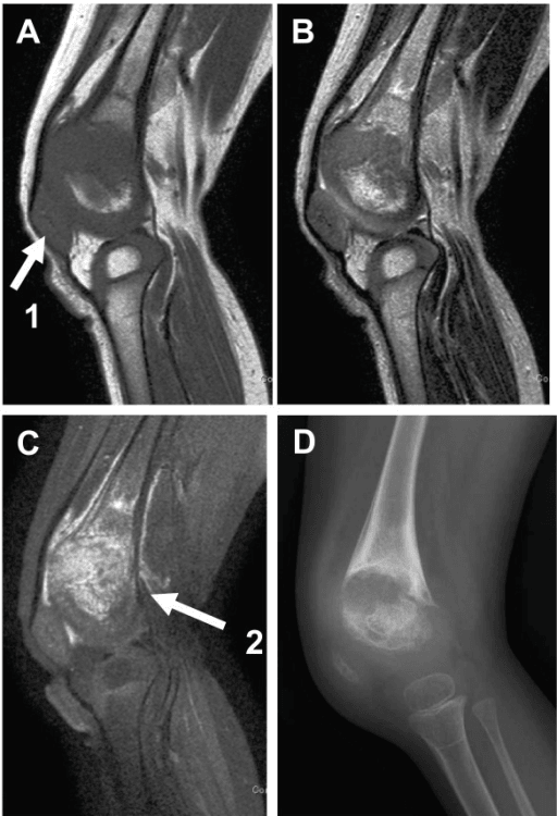 Three sagittal MRI sequences of a child's left knee alongside a lateral knee radiograph.