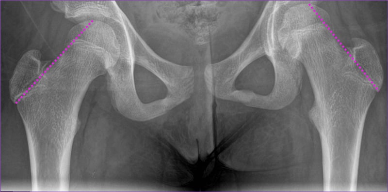 Anteroposterior pelvic radiograph of a 12-year-old with Klein’s line drawn along the superior femoral neck intersecting the epiphysis on both sides.