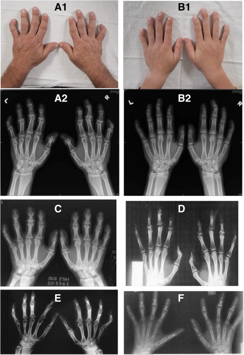 Clinical hand photographs and serial radiographs showing familial digital arthropathy-brachydactyly in two related patients.