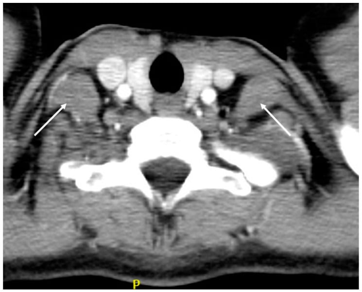 Axial contrast CT showing bilateral anterior scalene muscle hypertrophy