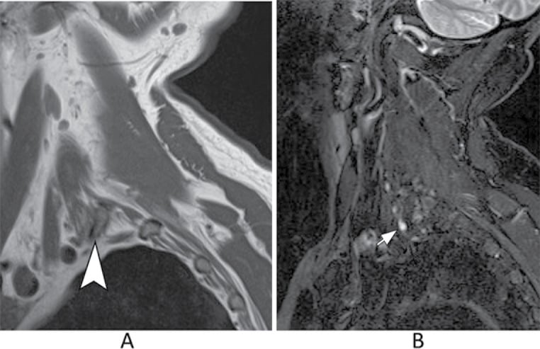 Sagittal brachial plexus MRI showing a cervical rib with abnormal thickening and signal of the C8 root