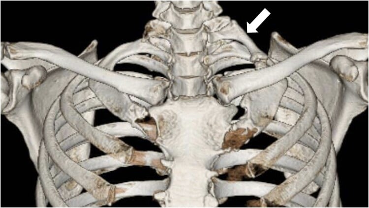 Three-dimensional CT reconstruction showing cervical rib pseudarthrosis at the thoracic outlet