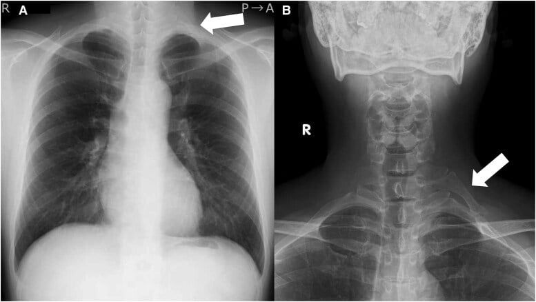 Chest and cervical spine radiographs showing a unilateral cervical rib
