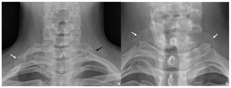 Paired cervical radiographs showing complete and incomplete cervical ribs and elongated C7 transverse processes