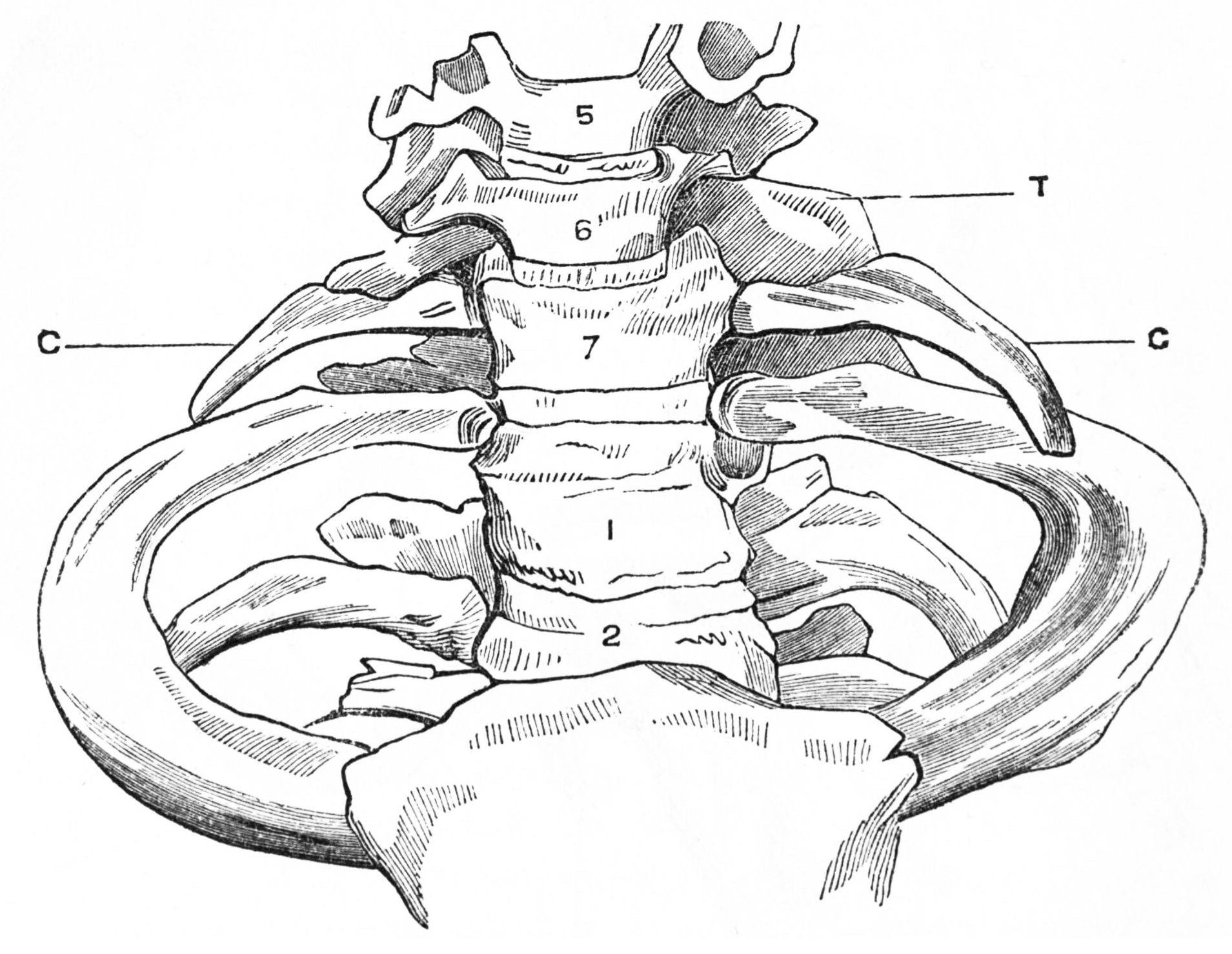Anatomical drawing of bilateral cervical ribs arising from the C7 vertebra above the first ribs