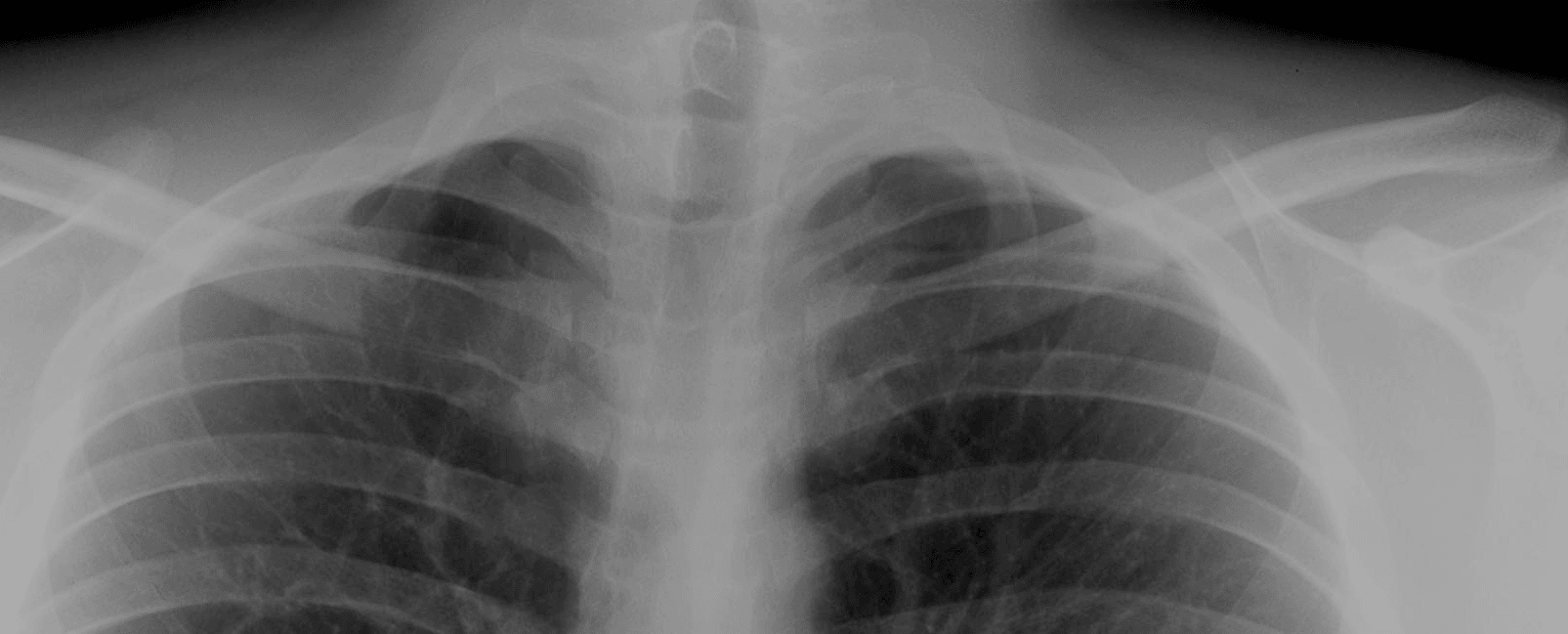 Frontal chest radiograph showing bilateral cervical ribs