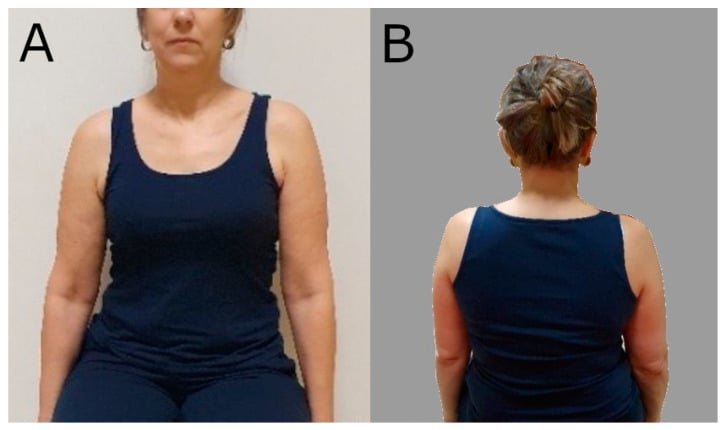 Front and back clinical views showing depression of the symptomatic shoulder girdle