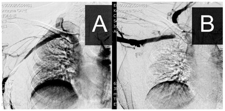 Paired venograms at rest and arm abduction showing costoclavicular subclavian vein occlusion