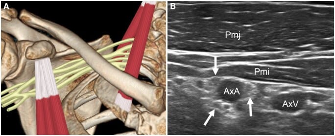 Schematic and ultrasound of the infraclavicular plexus cords around the axillary artery beneath pectoralis minor