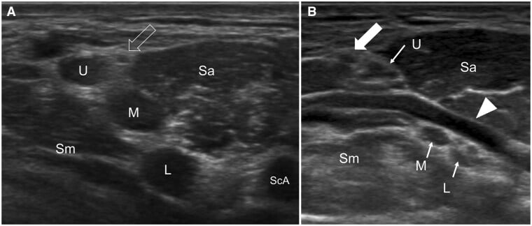 Transverse ultrasound identifying upper, middle and lower brachial plexus trunks in the interscalene gap