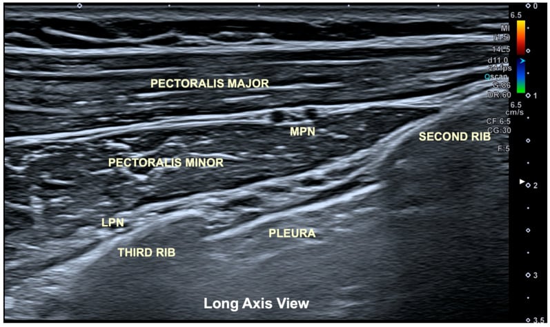 Long-axis ultrasound showing pectoralis major, pectoralis minor, medial and lateral pectoral nerves, ribs and pleura