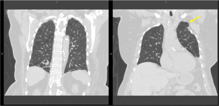Coronal chest CT showing apical lung herniation through a prior first-rib resection defect