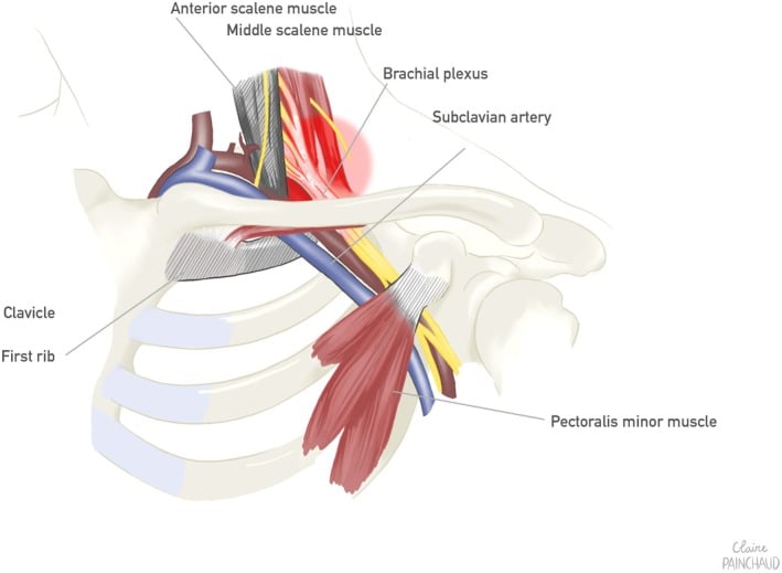 Schematic of recurrent thoracic outlet syndrome caused by perineural scar fibrosis after prior decompression
