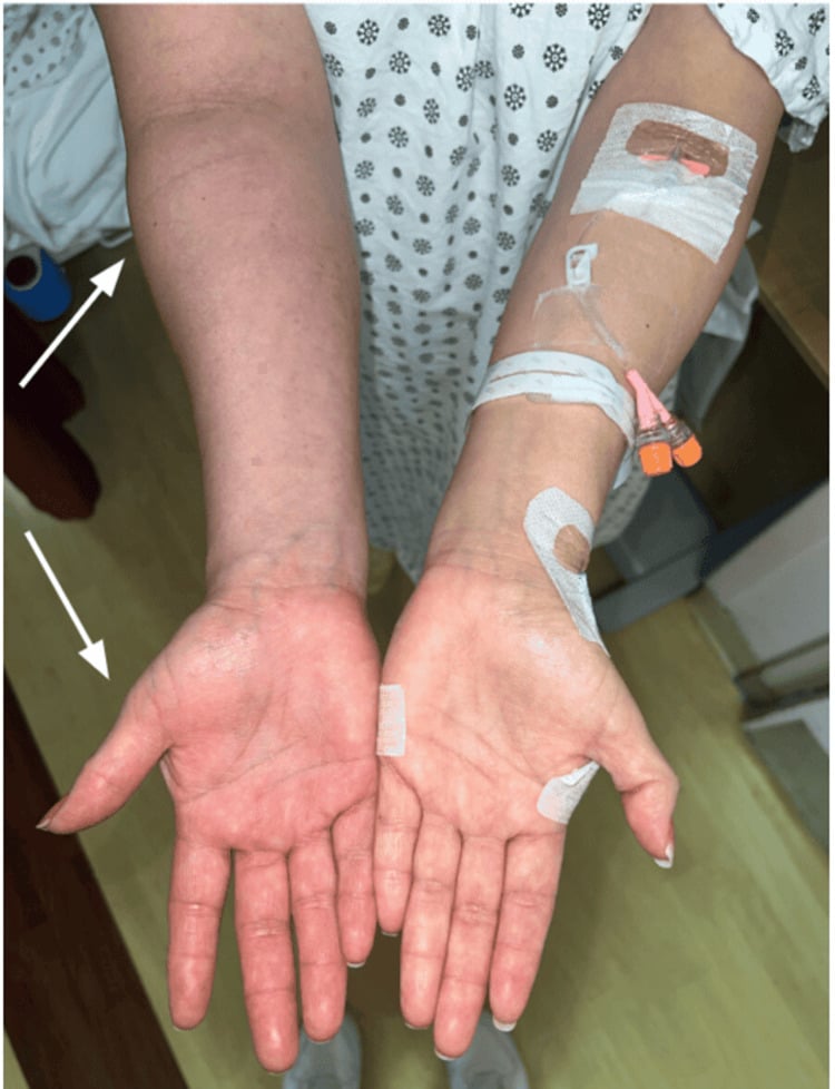 Side-by-side clinical photographs showing unilateral erythema and oedema from venous congestion