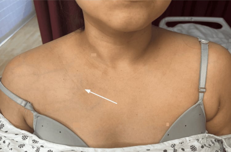 Clinical photograph showing unilateral superficial venous engorgement over the shoulder and upper chest