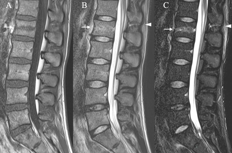 Sagittal T1, T2 and STIR MRI showing an L1 fracture with supraspinous and interspinous ligament disruption at T12-L1.