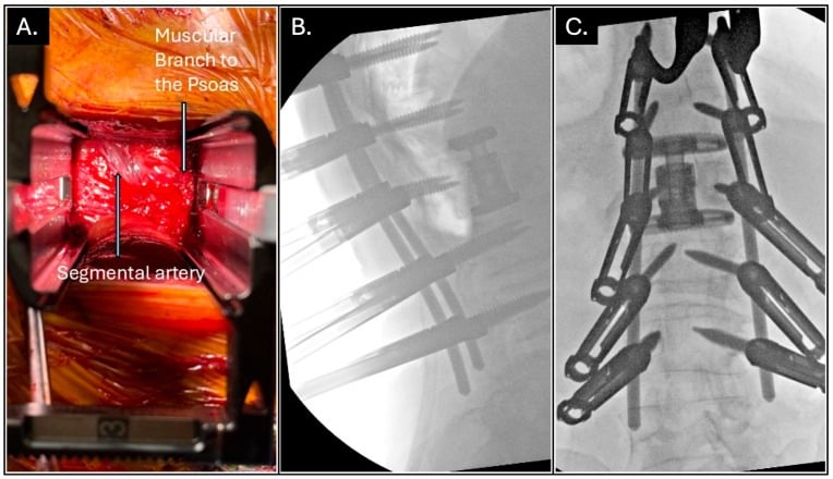 Lateral operative corridor and AP and lateral fluoroscopy showing thoracolumbar corpectomy cage reconstruction with posterior instrumentation.