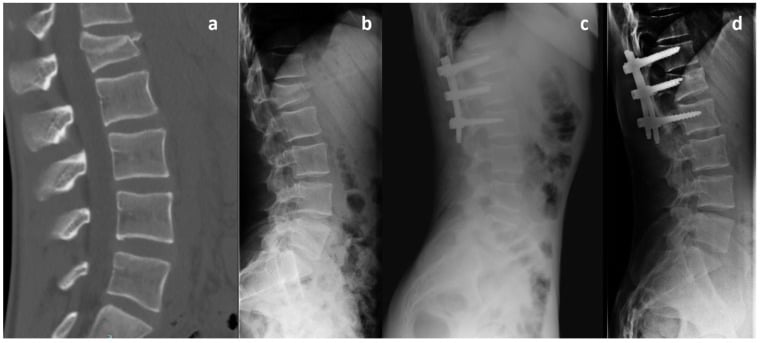 Preoperative CT and lateral radiograph of an L1 AO A3 burst fracture with postoperative short-segment fixation including fracture-level pedicle screws.