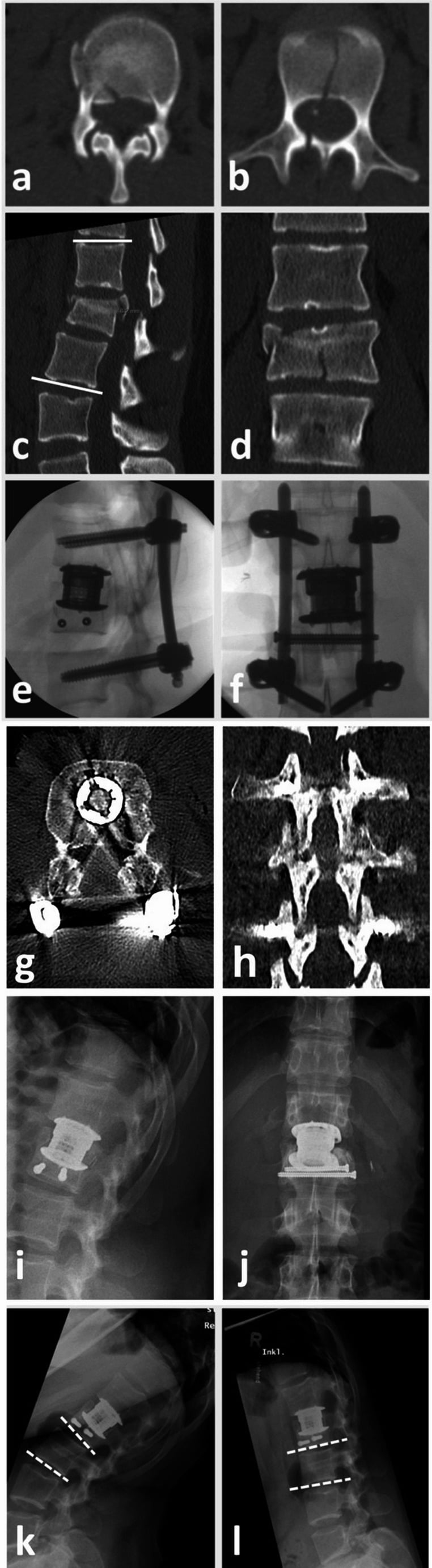 Axial and sagittal CT, MRI and radiographs of an L2 complete burst-split fracture with associated posterior tension-band injury.
