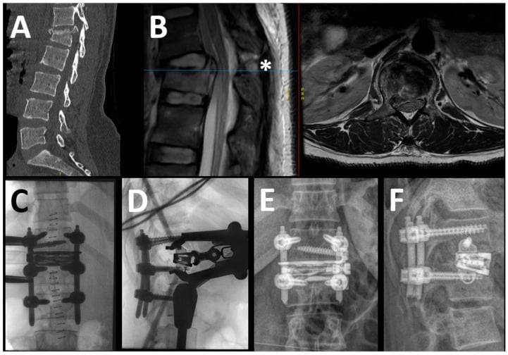 Sagittal CT and T2 MRI showing an L1 complete burst fracture with posterior ligamentous complex disruption, followed by operative reduction and fixation.