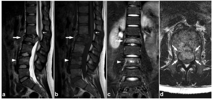 Multiplanar MRI of an L2 burst fracture with retropulsed fragment compressing the conus medullaris and associated cord oedema.