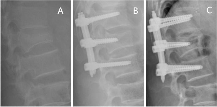 Serial lateral radiographs of an L1 burst fracture showing initial kyphosis correction followed by recurrent deformity before and after implant removal.
