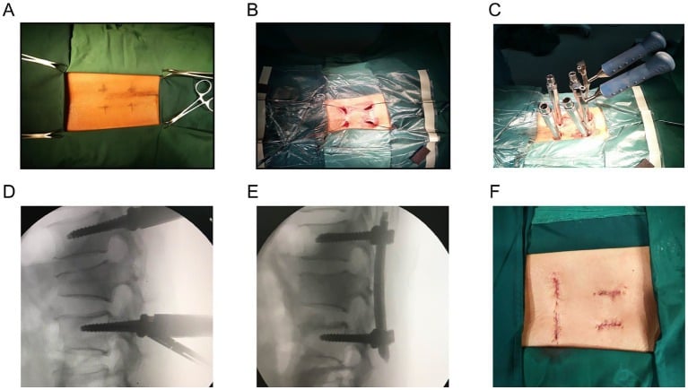 Sequential operative images showing percutaneous pedicle access, guidewire placement, rod insertion and fluoroscopic reduction of a thoracolumbar fracture.