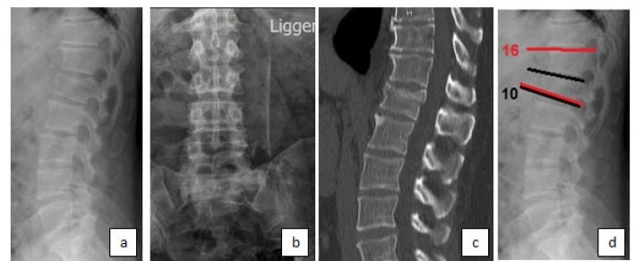 AP and lateral radiographs plus sagittal CT of an L1 AO A3 burst fracture with minimal kyphosis and no posterior ligamentous complex injury.