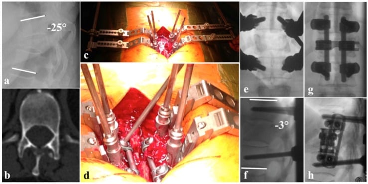 Preoperative imaging and intraoperative photographs showing cantilever reduction and pedicle-screw fixation of a kyphotic B2/A4 thoracic fracture.