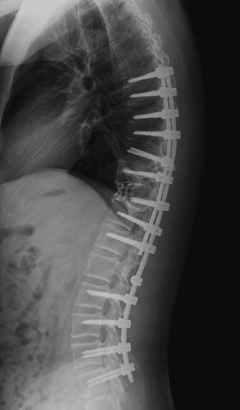 Lateral spine radiograph after a three-column pedicle subtraction osteotomy with a long pedicle-screw-and-rod construct correcting a kyphotic deformity.