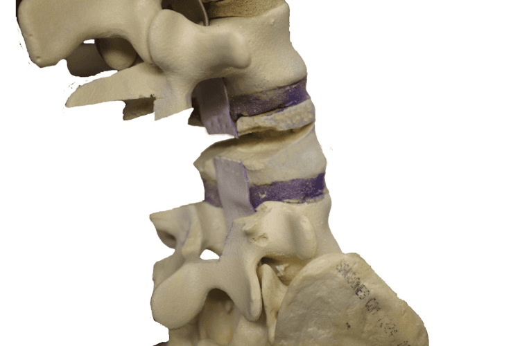 Lateral sawbone view after pedicle cuts and vertebral body decancellation, a defect left in the vertebral body.
