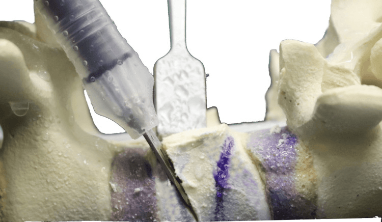 Sawbone demonstration of a cutting instrument making the inferior vertebral body cut below a pedicle during wedge preparation.