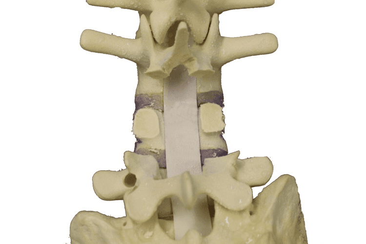 Posterior sawbone view showing bilateral pedicle exposure after decompression.