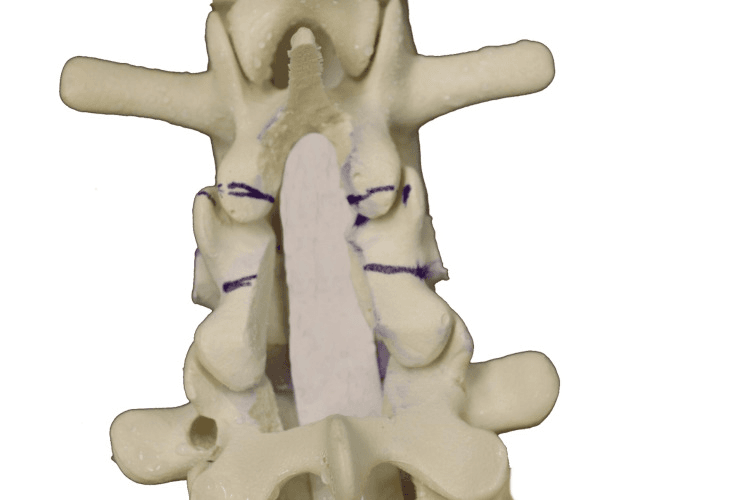 Posterior view of a sawbone model after a central laminectomy, with purple ink marking the planned laminotomy and facet cuts for a pedicle subtraction osteotomy.