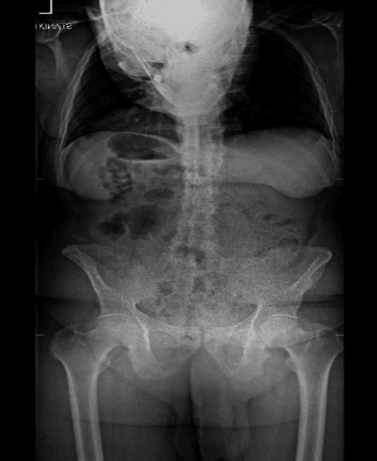 Standing anteroposterior radiograph before pedicle subtraction osteotomy, the skull projected over the upper thorax, with the pelvis and proximal femora included.