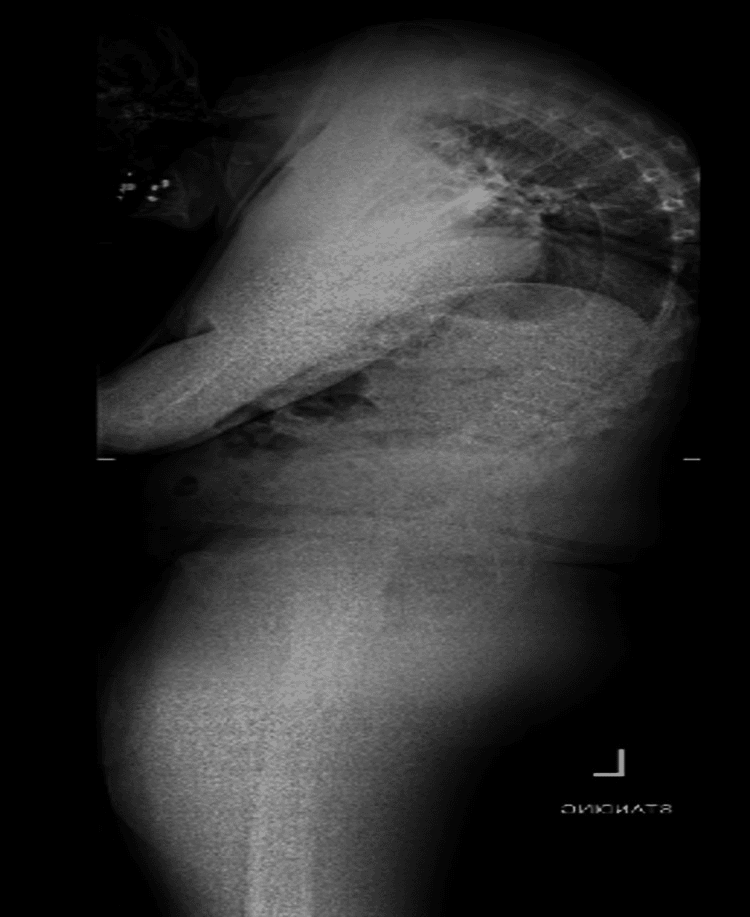 Standing lateral radiograph of a severe cervicothoracic deformity before correction, the head and upper trunk pitched forward.
