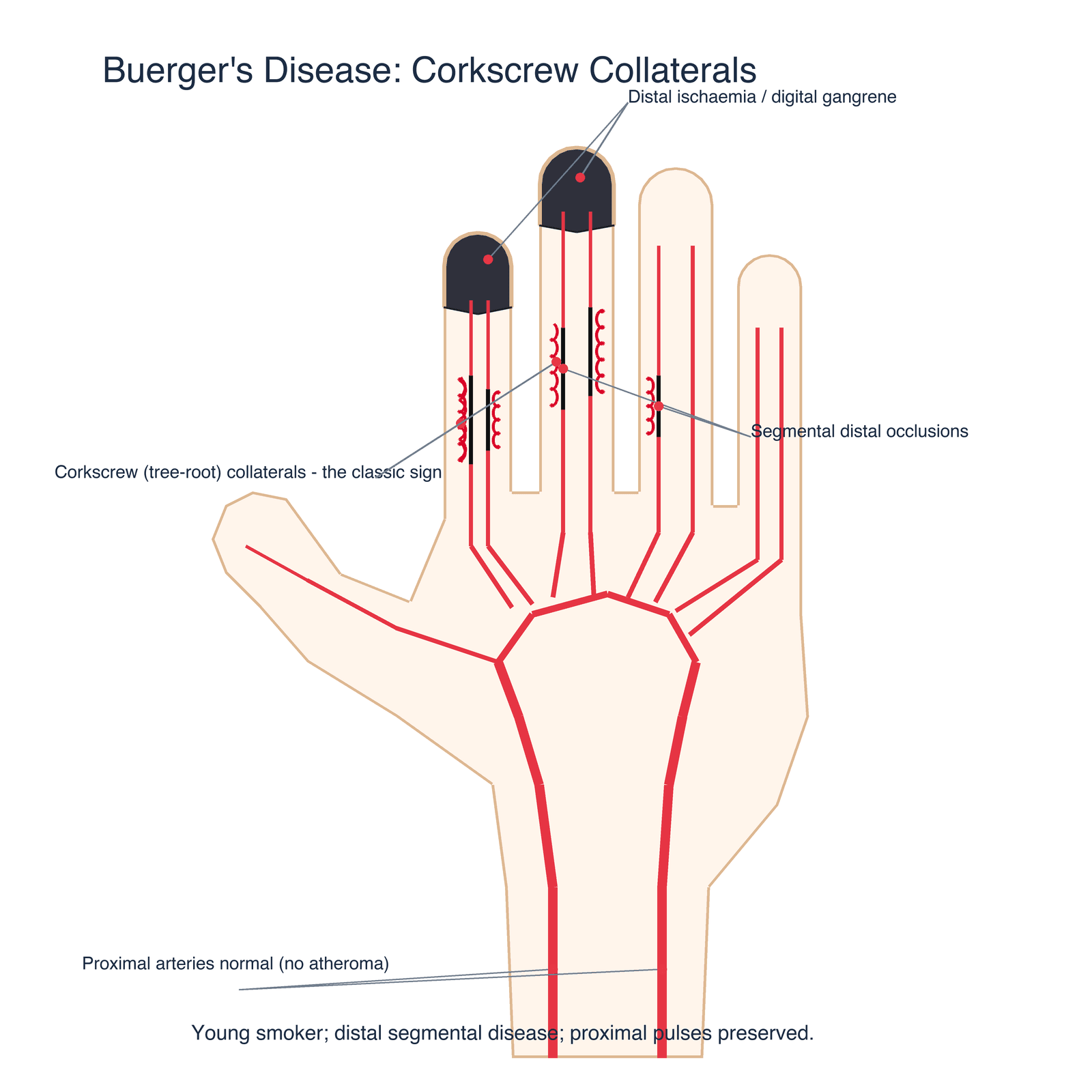 Diagram of the hand arteries in Buerger's disease showing normal proximal arteries, segmental distal occlusions, tortuous corkscrew collaterals and gangrenous fingertips