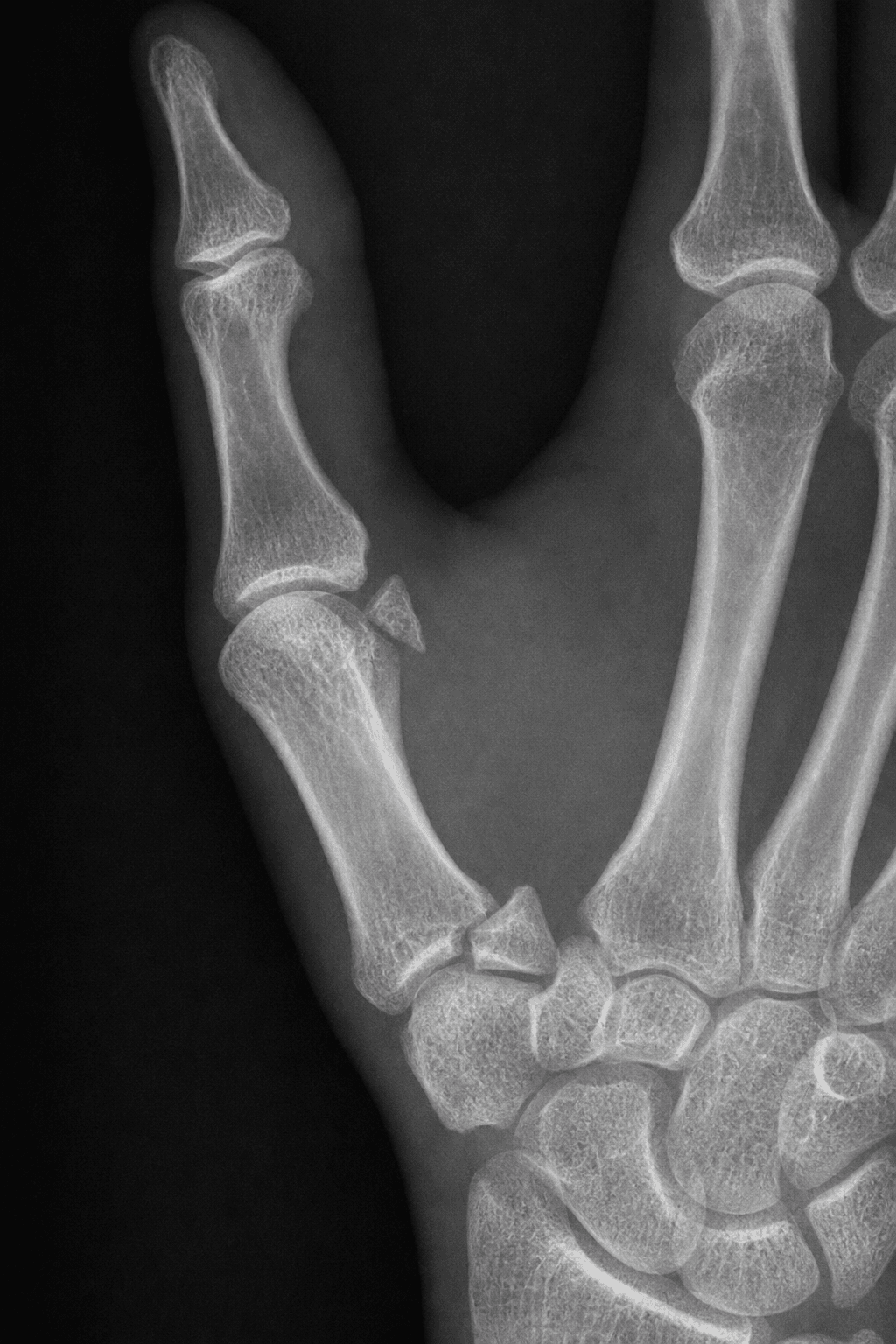 AP thumb radiograph showing an intra-articular fracture at the base of the first metacarpal with carpometacarpal subluxation, a Bennett fracture-dislocation.