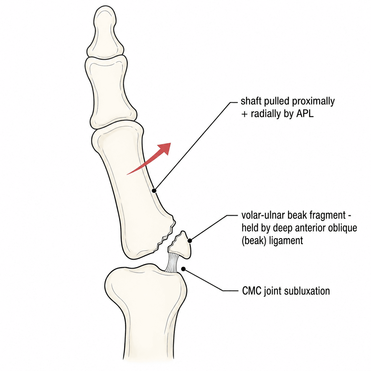 Schematic diagram of a Bennett fracture-dislocation showing the volar-ulnar beak fragment and proximal-radial shaft displacement