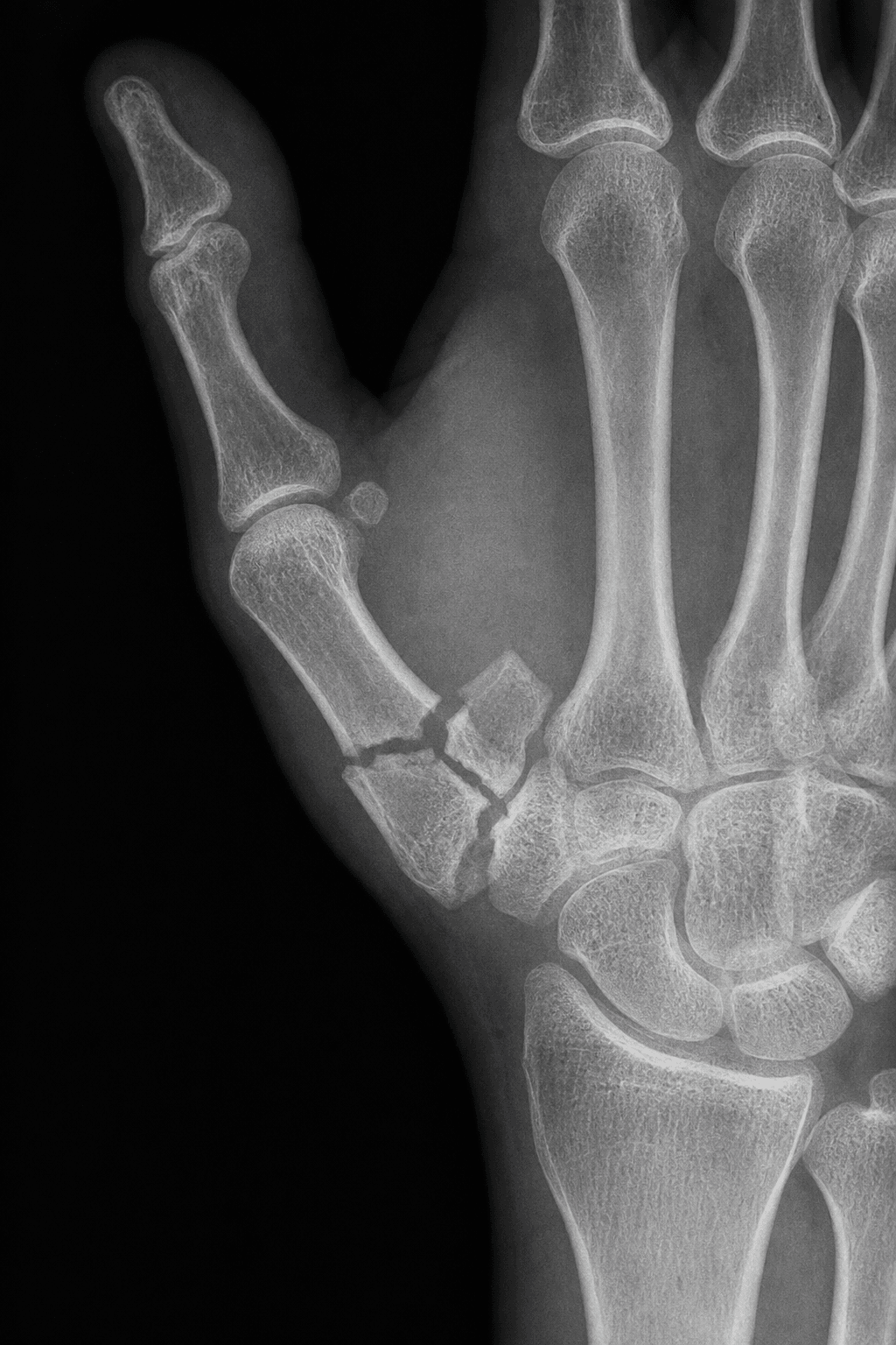 PA thumb radiograph showing a comminuted intra-articular fracture of the base of the first metacarpal, a Rolando fracture.