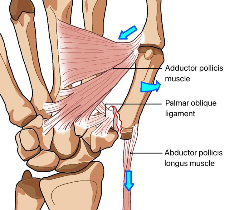 Diagram showing the ligament and muscle forces acting on a Bennett fracture