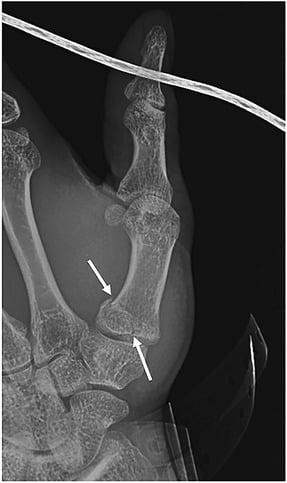 Radiograph with two arrows marking an oblique intra-articular Bennett fracture at the first metacarpal base