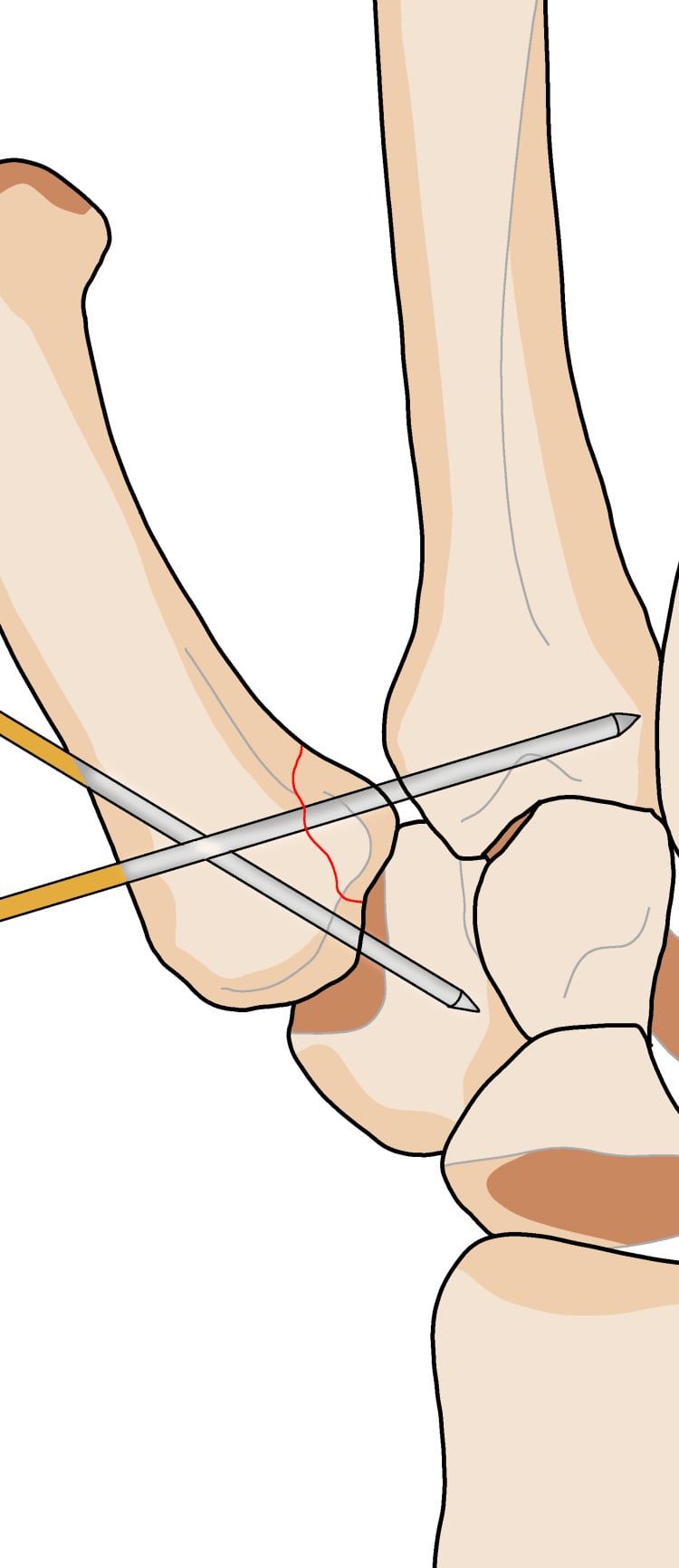 Diagram showing two K-wires in the first metacarpal, one directed toward the trapezium and one into the second metacarpal base