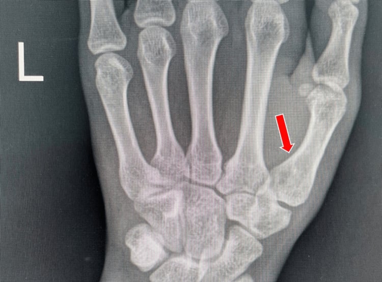 Hand radiograph marked L after K-wire removal showing maintained Bennett fracture reduction